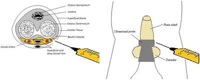 Pediatric ultrasound-guided dorsal penile nerve block and sedation in spontaneous breathing: a prospective observational study